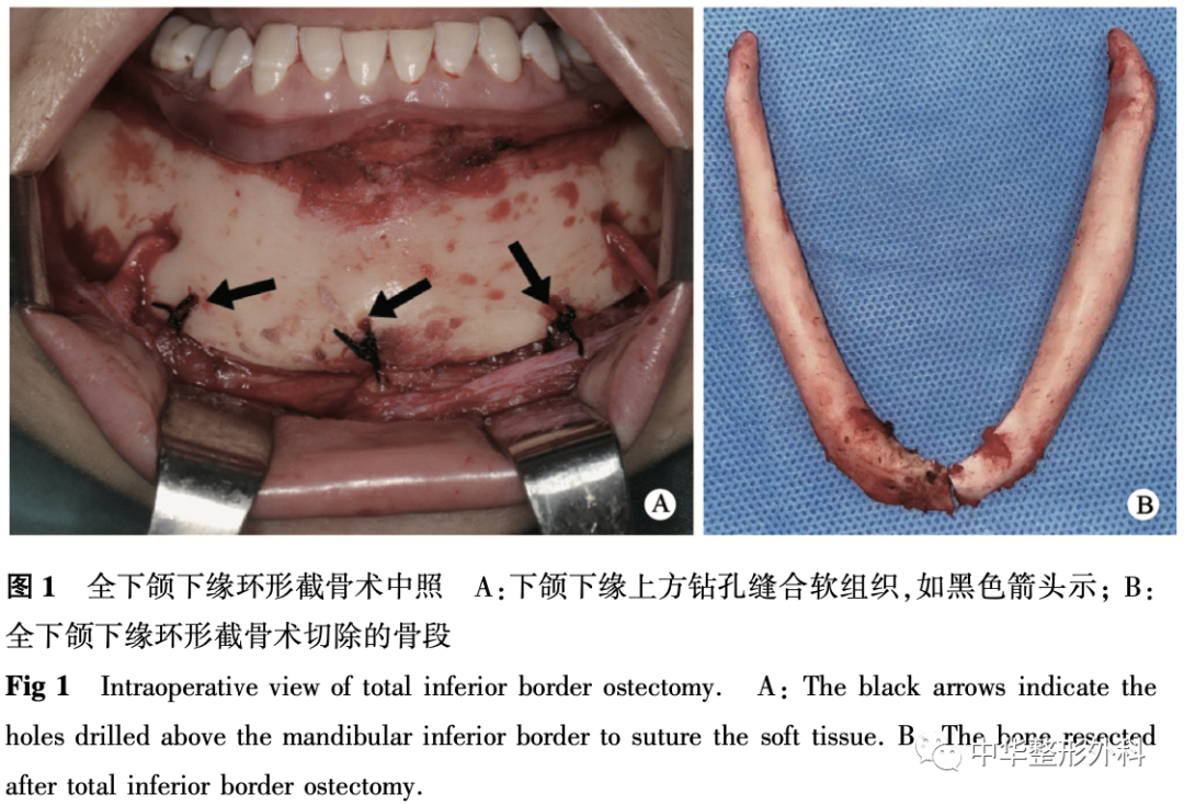 全下颌下缘环形截骨术与T形颏成形术合并下颌角截骨术对比研究