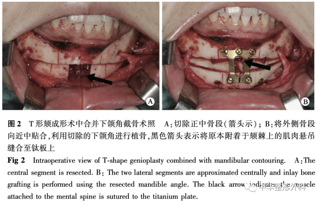 全下颌下缘环形截骨术与T形颏成形术合并下颌角截骨术对比研究