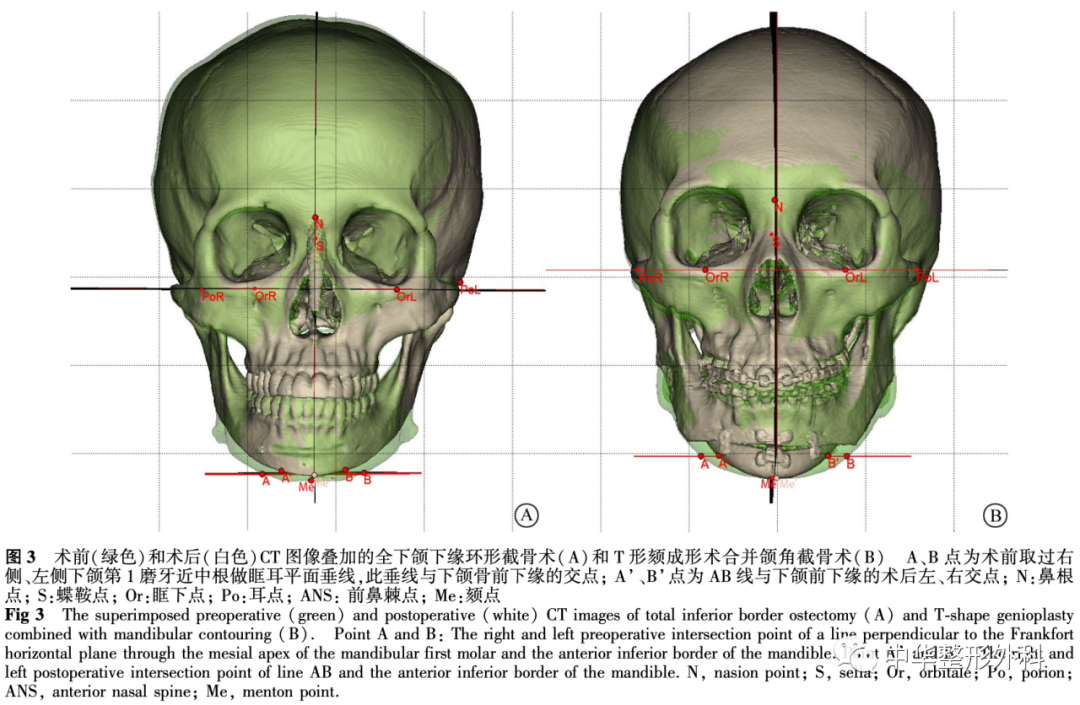 全下颌下缘环形截骨术与T形颏成形术合并下颌角截骨术对比研究