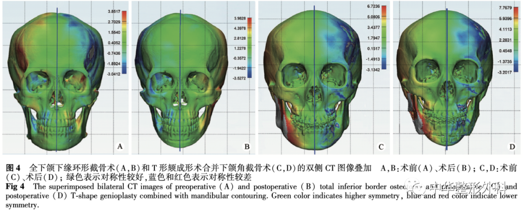 全下颌下缘环形截骨术与T形颏成形术合并下颌角截骨术对比研究