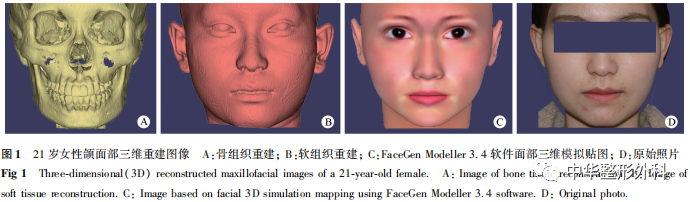 上海地区青年女性下颌三维测量及其在下颌角肥大诊疗中的价值