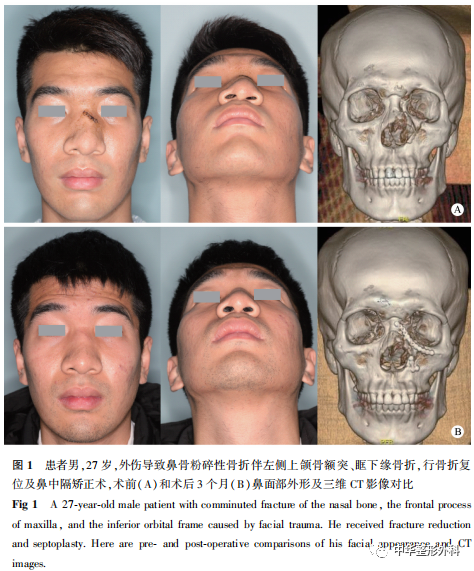 上颌骨额突区骨折继发鼻面部畸形手术整复效果评估