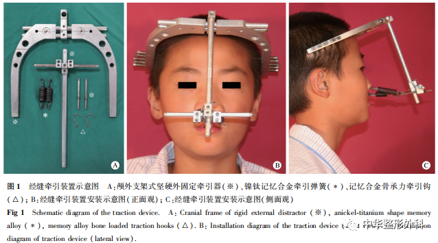 经缝牵引成骨术后患儿颧骨、环颧骨周缝及颧弓的变化