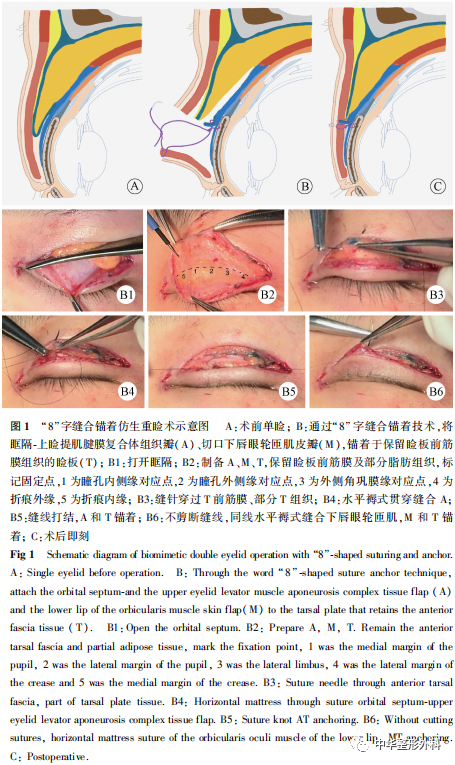 "8"字缝合锚着仿生重睑术