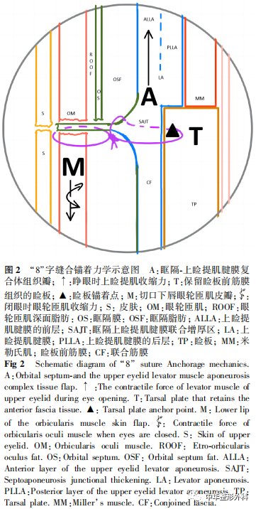 "8"字缝合锚着仿生重睑术