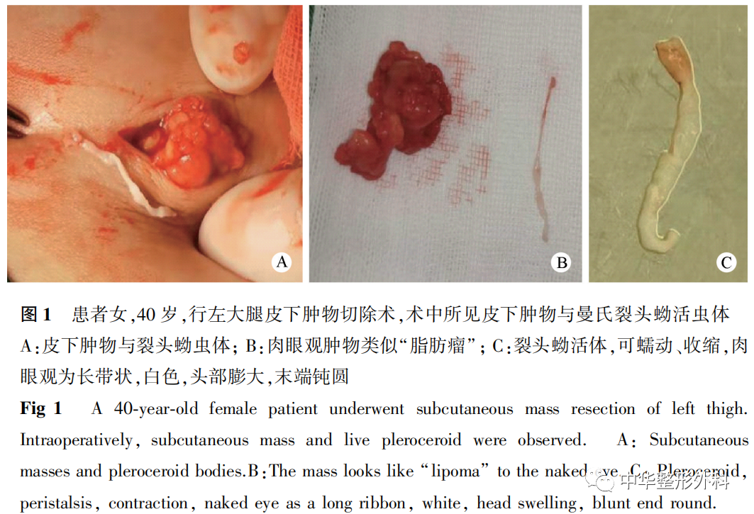 大腿皮下裂头蚴病误诊为脂肪瘤1例