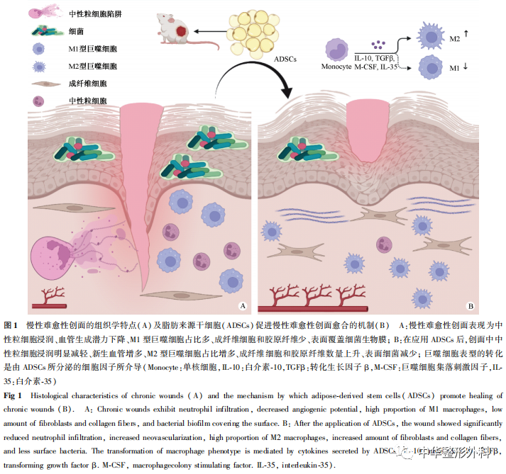 脂肪来源干细胞及其衍生物应用于慢性难愈性创面的研究进展