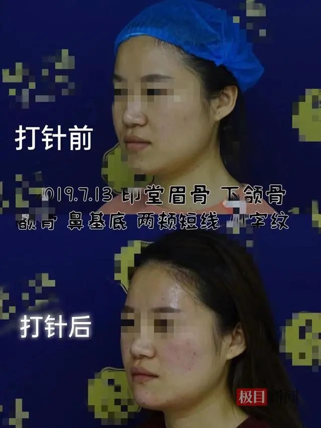 女子称花数十万整容后脸上出现肿块，美容机构：是否属于医疗事故需专业机构鉴定！