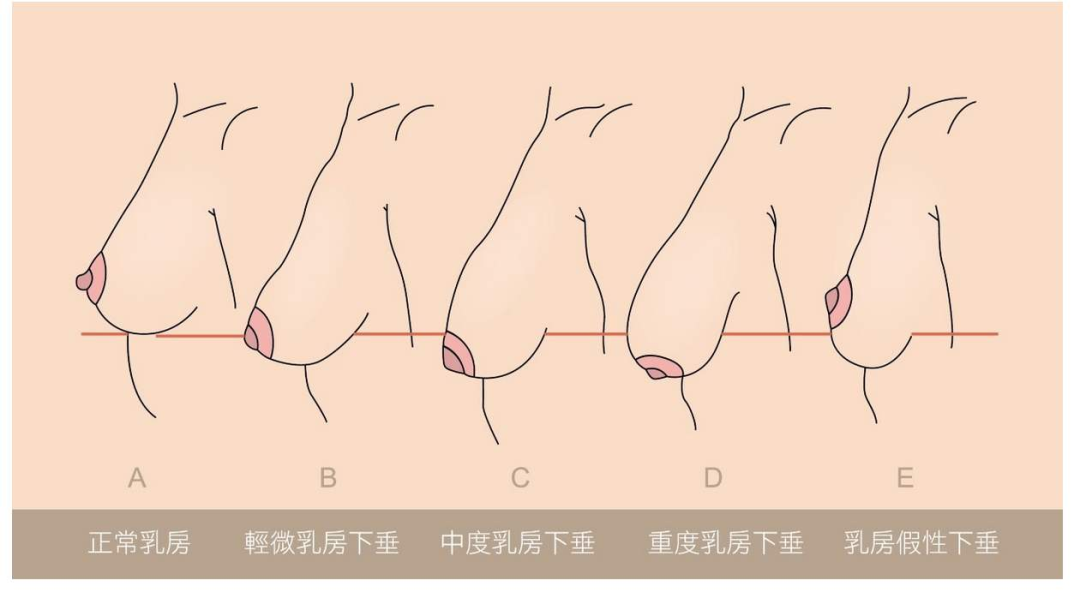 【手术模特招募】摆脱身材焦虑，乳房下垂也能恢复挺拔曲线！