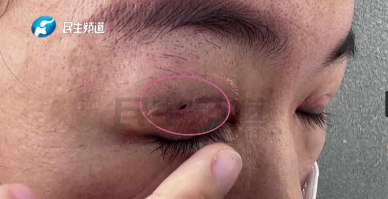 女子修复双眼皮后……竟多了个洞！