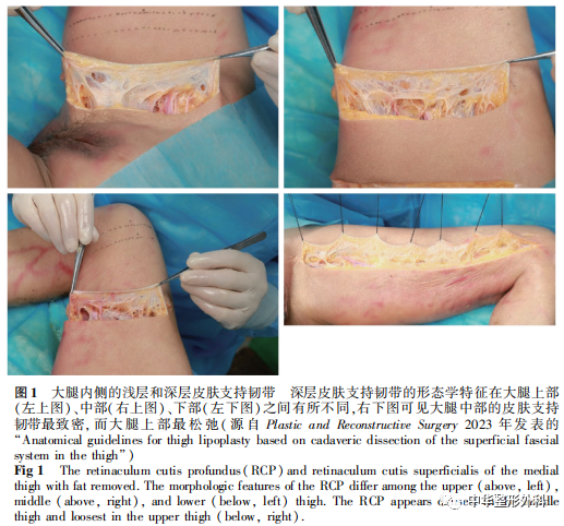 关于皮下脂肪组织浅筋膜系统解剖的系列研究