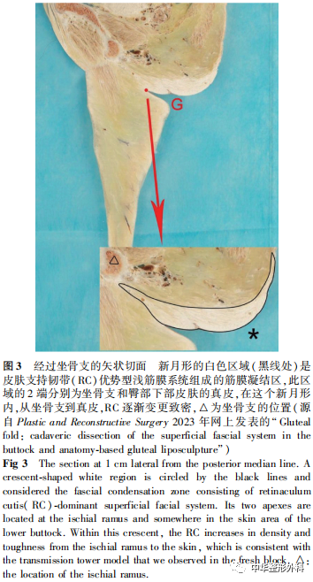 关于皮下脂肪组织浅筋膜系统解剖的系列研究