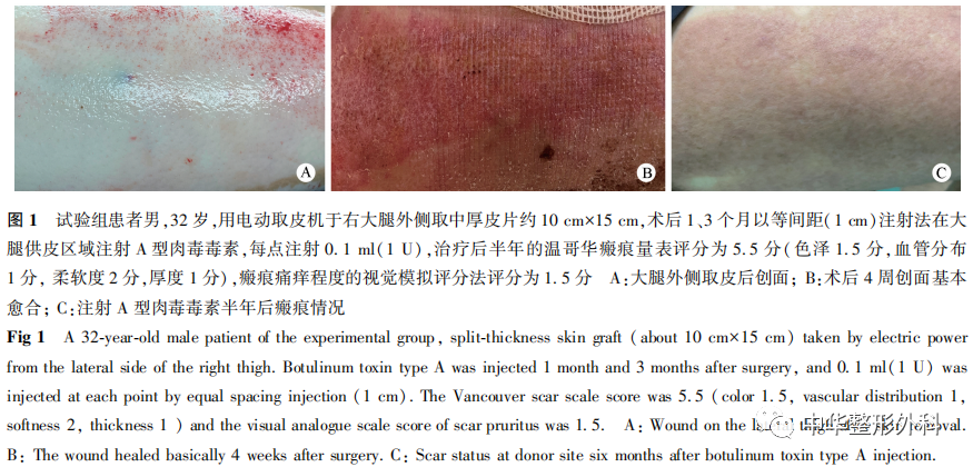 A型肉毒毒素注射防治中厚皮片供区瘢痕的效果