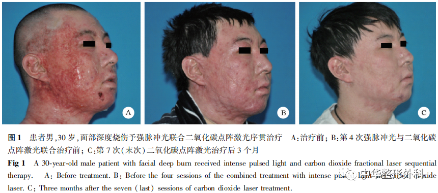 基于温哥华瘢痕量表评分的强脉冲光联合二氧化碳点阵激光序贯治疗深度烧伤后早期增生性瘢痕的效果