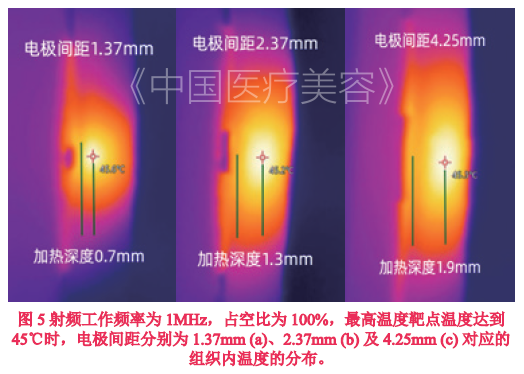 【基础研究】机电参数对双极射频皮下温度分布的影响研究