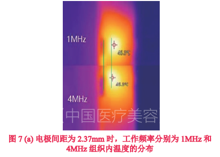 【基础研究】机电参数对双极射频皮下温度分布的影响研究