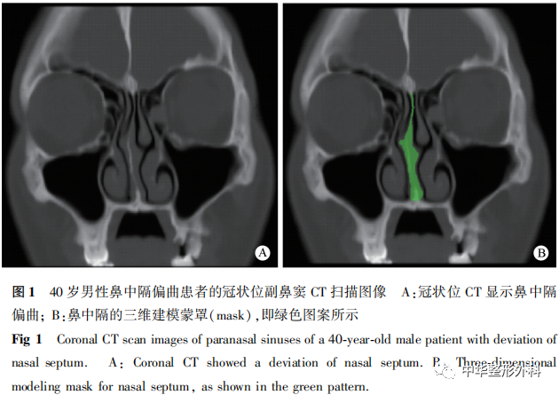 鼻中隔偏曲矫正手术前后鼻中隔生物力学三维有限元分析