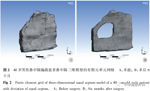 鼻中隔偏曲矫正手术前后鼻中隔生物力学三维有限元分析