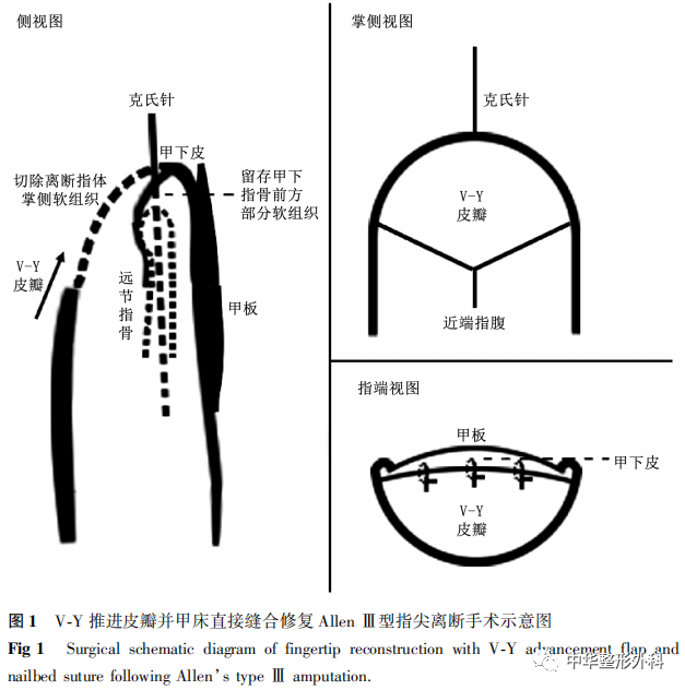 V-Y推进皮瓣并甲床直接缝合修复Allen Ⅲ型指尖离断16例