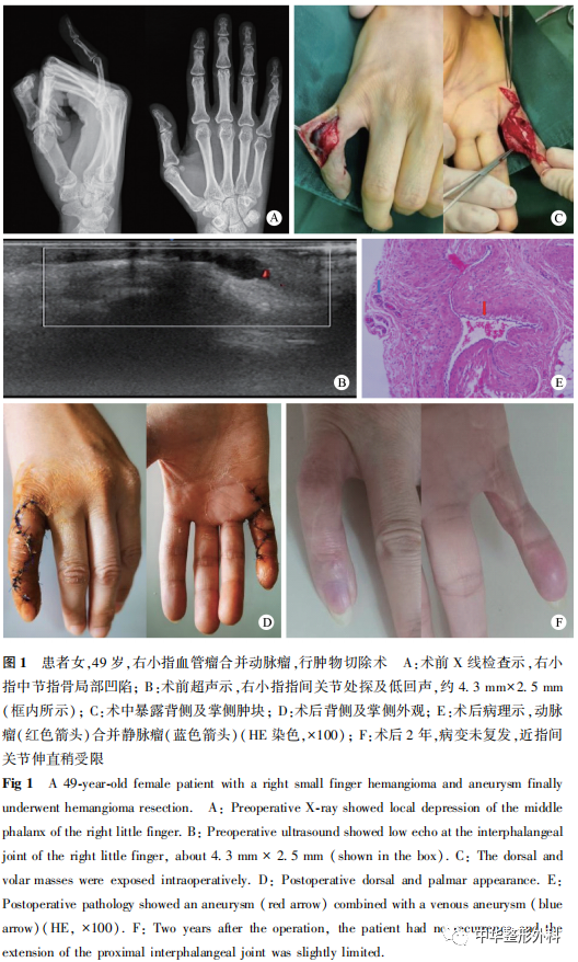 右小指血管瘤合并动脉瘤1例