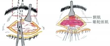 重度上睑下垂的治疗