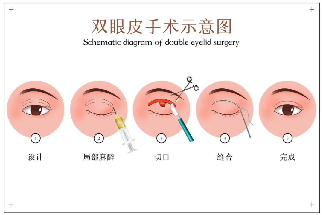 双眼皮手术是小手术？​在哪做都一样？