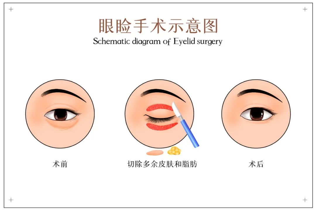 双眼皮手术是小手术？​在哪做都一样？