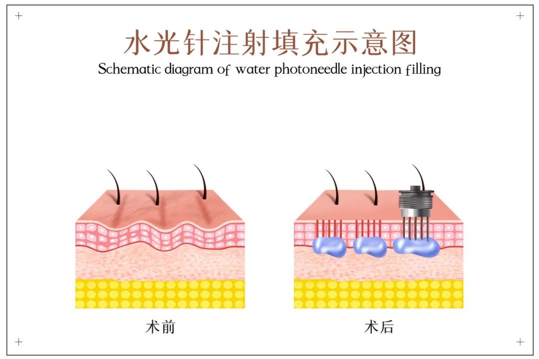 微针和水光适合哪些消费群体？