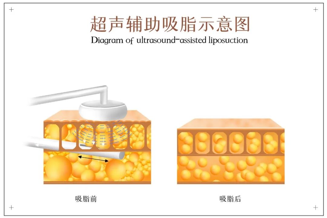 靠吸脂减的“肥”？会不会反弹？